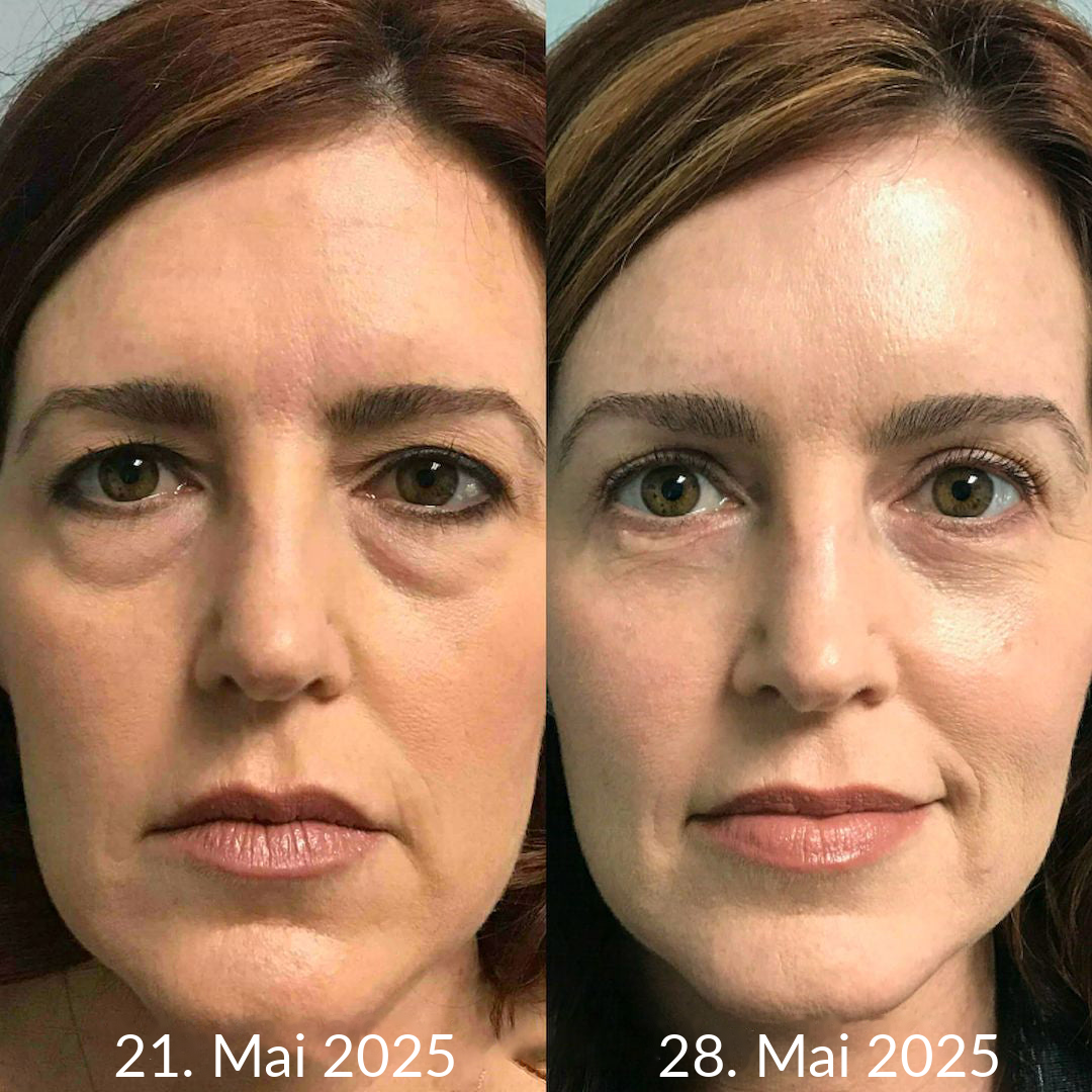 Hergestellt und versandt aus den DE 👉 💝 Healrize® Botox & Vita-A Retinol Shot – Straffende Creme gegen Falten (Wrinkle-Lift) – Aktion am letzten Tag: 60 % Rabatt 💝