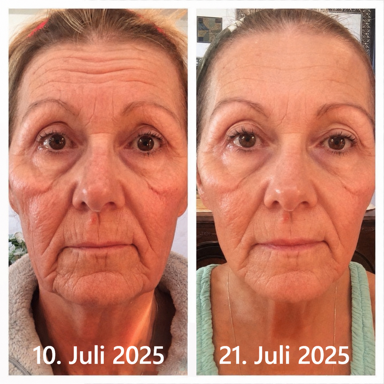 Hergestellt und versandt aus den DE 👉 💝 Healrize® Botox & Vita-A Retinol Shot – Straffende Creme gegen Falten (Wrinkle-Lift) – Aktion am letzten Tag: 60 % Rabatt 💝