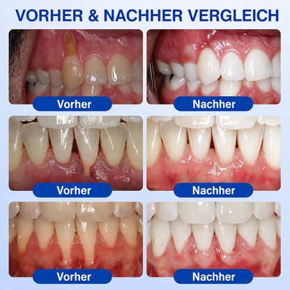 🦷💊Healrize® GumRevive Gel zur Regeneration des Zahnhalteapparats (bei Zahnfleischbluten, Zahnfleischrückgang und lockeren Zähnen)💊