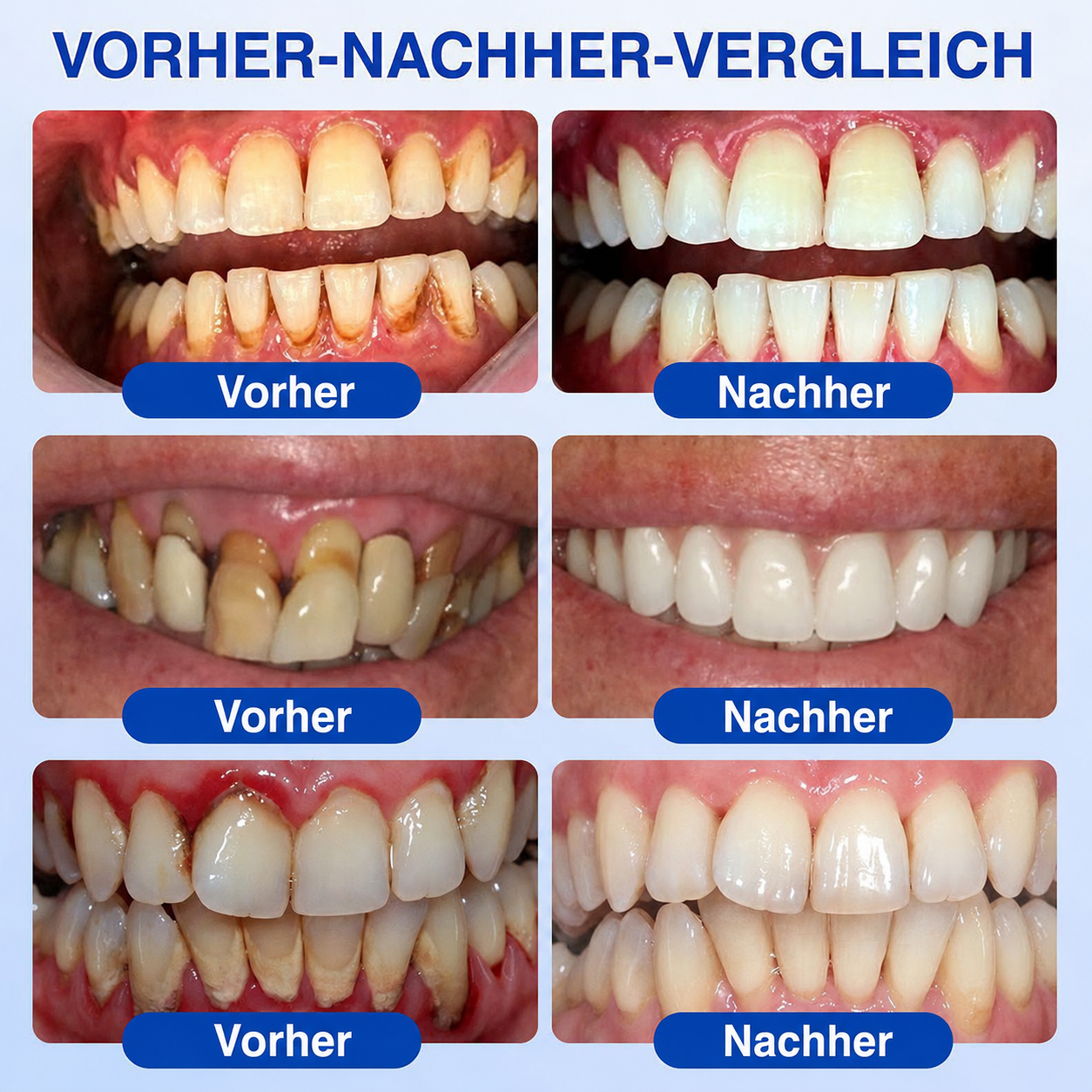 🦷💊Healrize® GumRevive Gel zur Regeneration des Zahnhalteapparats (bei Zahnfleischbluten, Zahnfleischrückgang und lockeren Zähnen)💊