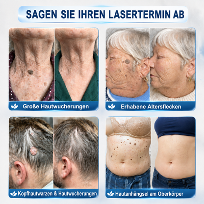 Healrize® 7-Tage Hautmal- & Flecken-Entferner 🌾(Schmerzfrei, Narbenfrei mit Rollball-Applikator)🌾