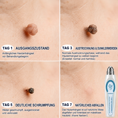 Healrize® 7-Tage Hautmal- & Flecken-Entferner 🌾(Schmerzfrei, Narbenfrei mit Rollball-Applikator)🌾