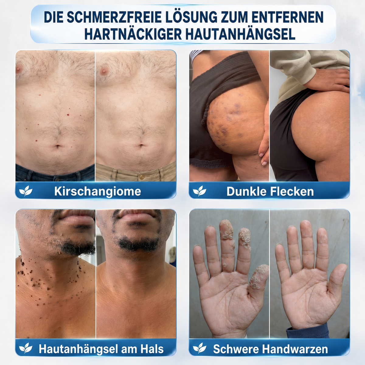 Healrize® 7-Tage Hautmal- & Flecken-Entferner 🌾(Schmerzfrei, Narbenfrei mit Rollball-Applikator)🌾